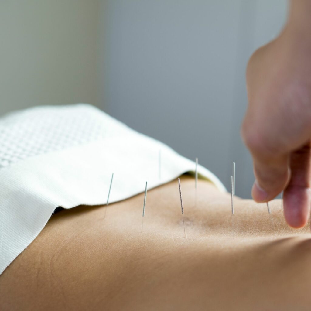 Acupuncture | Tigard Chiropractor | Rhodes Chiropractic