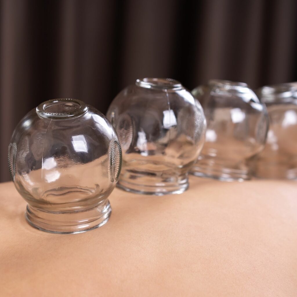 Cupping | Tigard Chiropractor | Rhodes Chiropractic